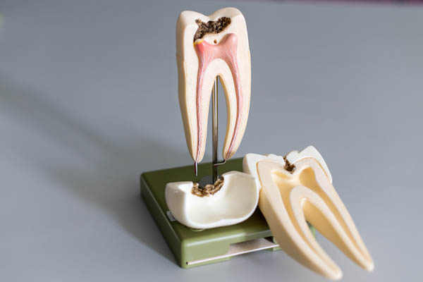 What Happens After Root Canal Therapy