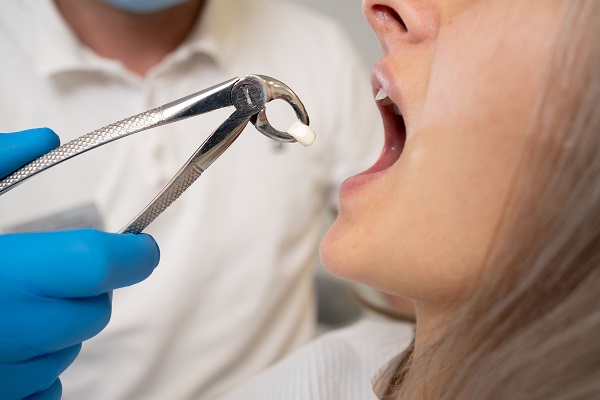 Common Myths And Facts About Wisdom Tooth Extraction